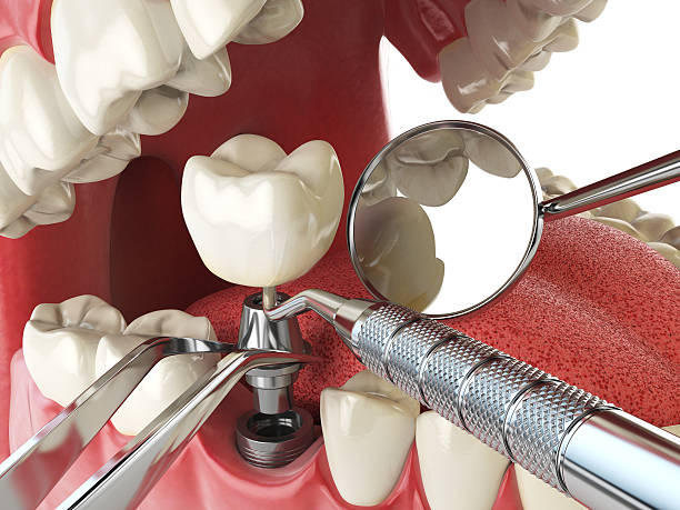 Best Emergency Root Canal Therapy in Egypt Lake Leto, FL